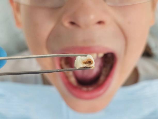Best Emergency Wisdom Teeth Removal in Green Valley, CA