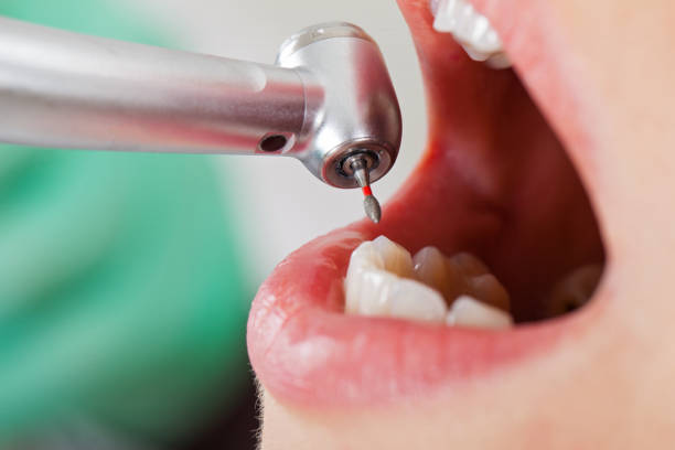 Best Emergency Tooth Extraction in Green Valley, CA